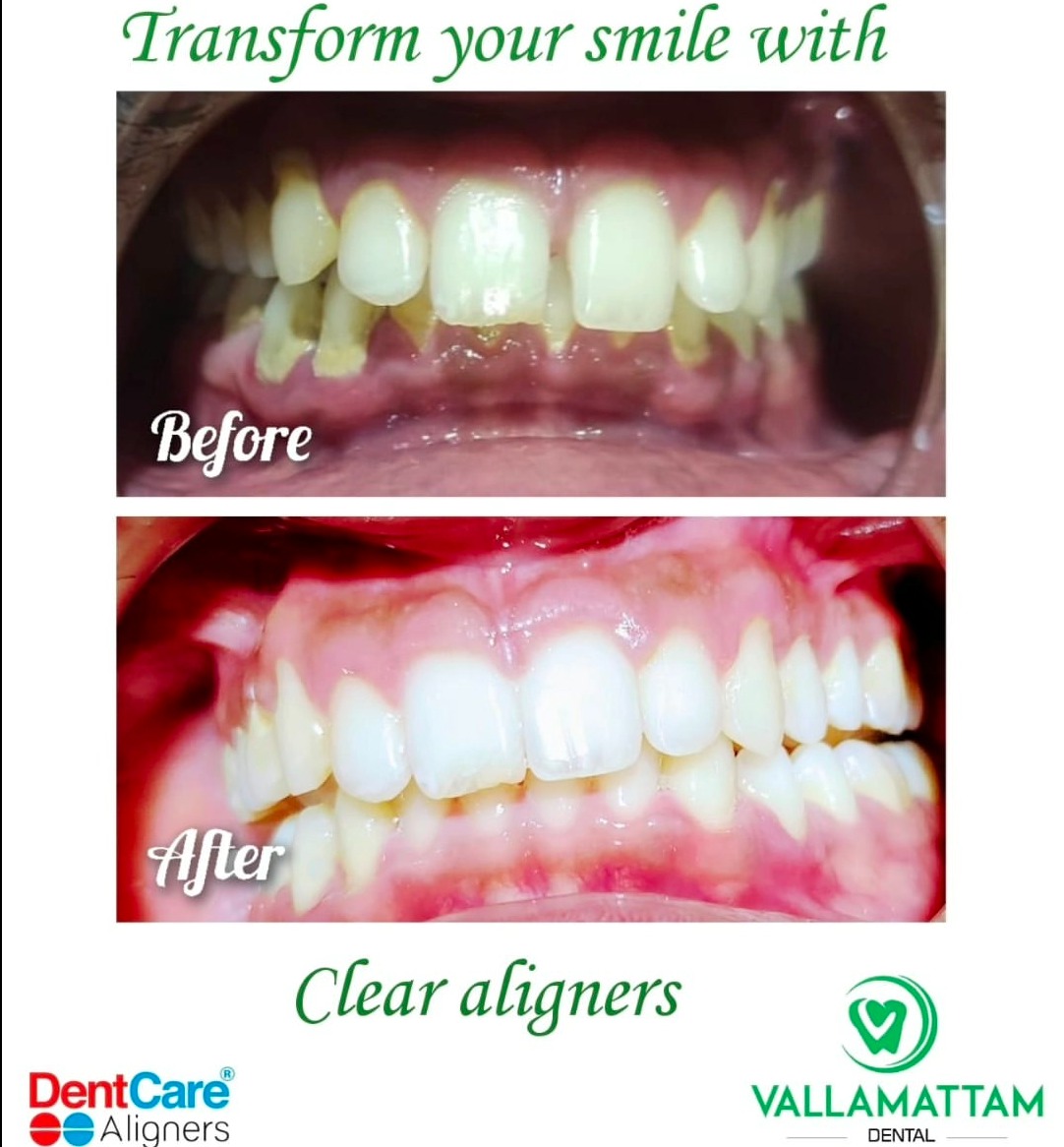 Dental Clinic Kakkanad Kochi, Dentist in Kakkanad Kochi, Vallamattam Dental 