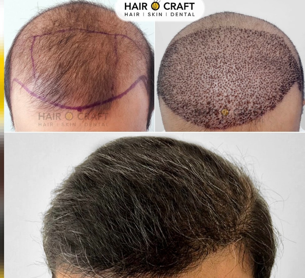 Hair Transplantation Clinic Vyttila Kochi,Skin Care Clinic Vyttila Kochi,Hair O Craft 
