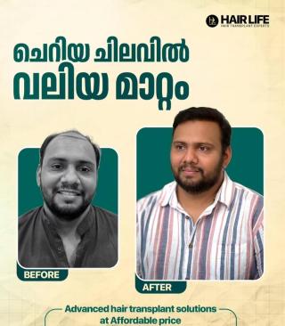 Hair Transplantation Clinic Kakkanad Kochi, Hair & skin clinic Kakkanad Kochi, Hair life skin & hair Transplantation clinic 