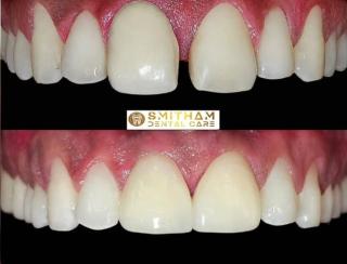 Dental clinic in venpalakara mayyanad kollam,Dentist in venpalakara,Kids dentistry in venpalakara,Smile makeovers in venpalakara,Smitham Dental Care 
