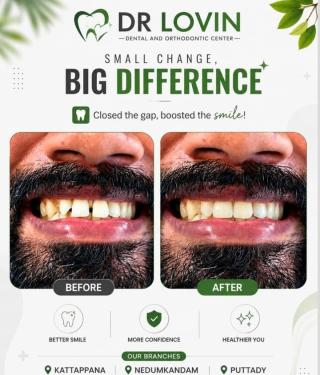  Dental Clinic in kattappana nedumkandam puttady,Orthodontic Centre in kattappana nedumkandam puttady,Dr Lovin Dental & Orthodontic Centre 